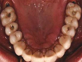 Screw Retained Dentures, Stage 3
