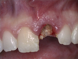 Single Dental Implant Case