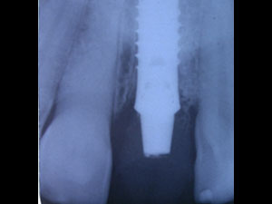 Single Dental Implant Case