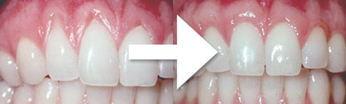 Before After for Soft Tissue Grafting