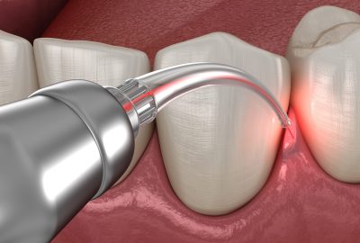 LANAP Laser Gum Treatment