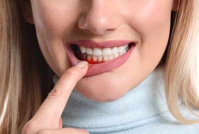 Periodontal Disease Treatment